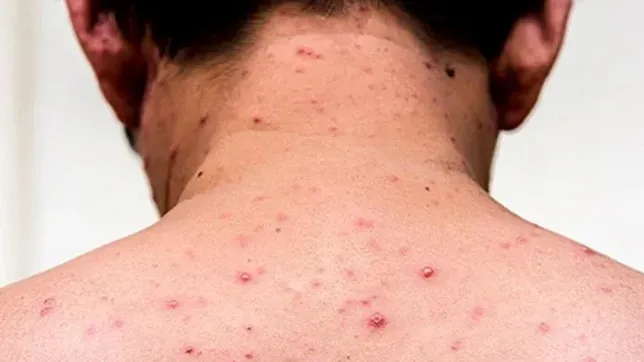 El instituto Malbrán confirmó el primer caso de sarampión del año en Argentina