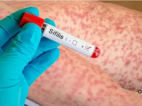 Alerta sanitaria: la sífilis superó los 55 mil casos en el último año en Argentina