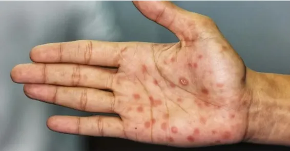 Crecen los casos de sífilis en Argentina: el alarmante dato que difundió el Ministerio de Salud